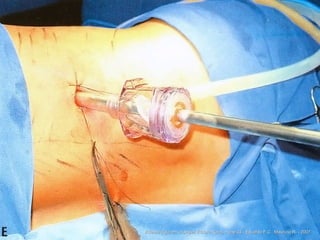 Videocirurgia em urologia, Editora Roca, – cap 33 - Eduardo F.C., Maurício R. - 2007 