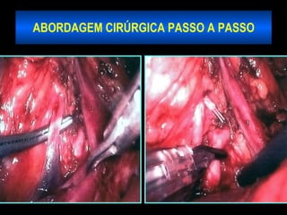 ABORDAGEM CIRÚRGICA PASSO A PASSO 