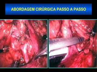ABORDAGEM CIRÚRGICA PASSO A PASSO 