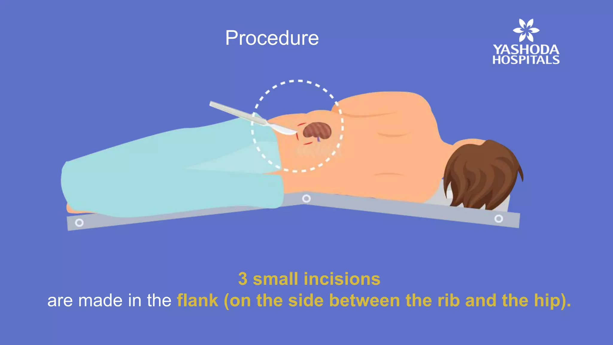 Flank Inscison What is Retroperitoneoscopic Surgery | PPTX