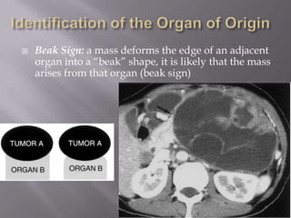    Beak Sign: a mass deforms the edge of an adjacent
    organ into a “beak” shape, it is likely that the mass
    arises from that organ (beak sign)
 