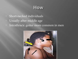    Short-necked individuals
   Usually after middle age
   Intrathracic goiter more common in men
 