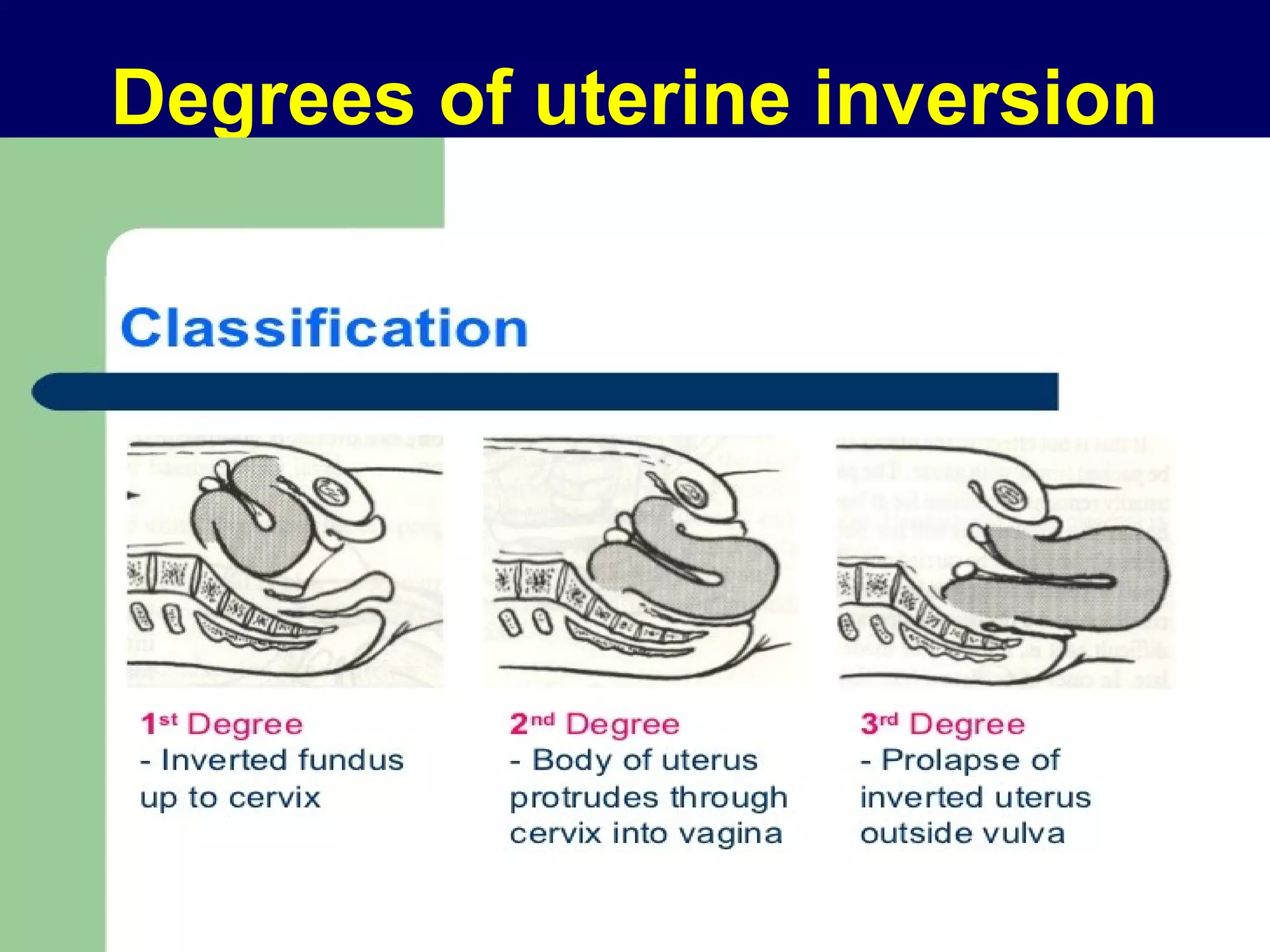 Degrees of uterine inversion
 
