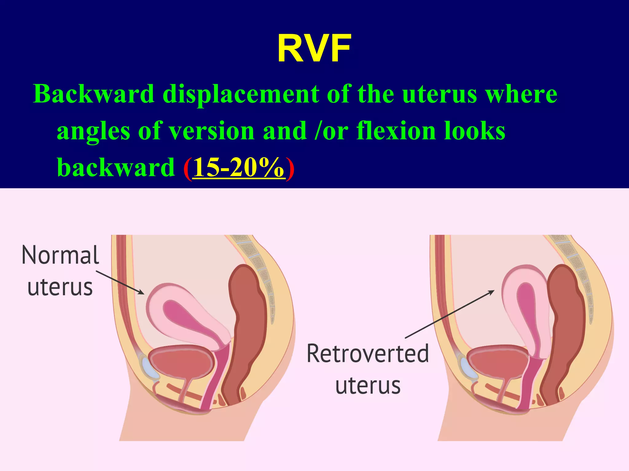 RVF
Backward displacement of the uterus where
angles of version and /or flexion looks
backward (15-20%)
 