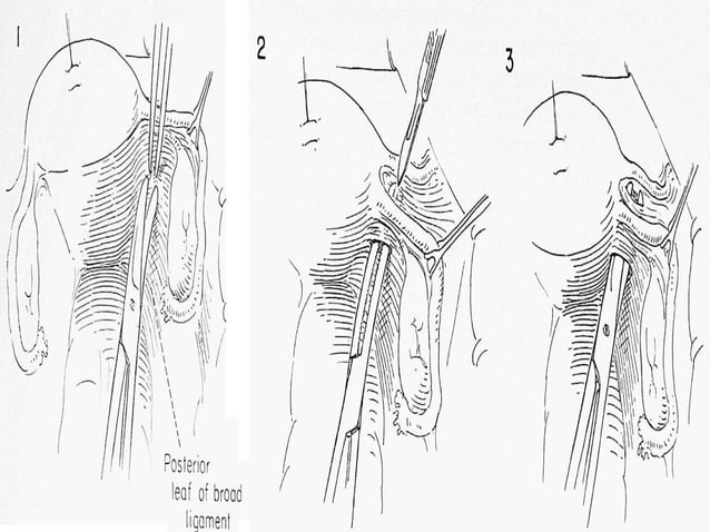 Retroverted retroflexed uterus &uterine inversion | PPT | Pregnancy ...