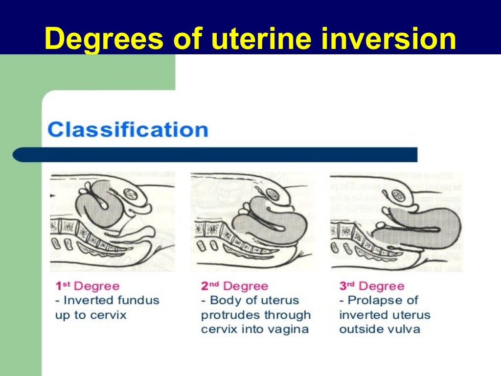 Retroverted retroflexed uterus &uterine inversion