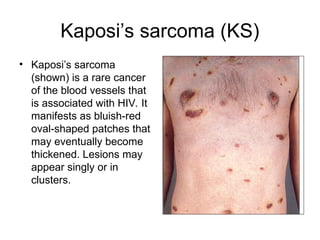 Kaposi’s sarcoma (KS)
• Kaposi’s sarcoma
(shown) is a rare cancer
of the blood vessels that
is associated with HIV. It
manifests as bluish-red
oval-shaped patches that
may eventually become
thickened. Lesions may
appear singly or in
clusters.
 