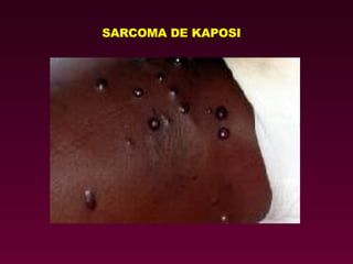 SARCOMA DE KAPOSI 