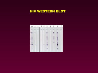 HIV WESTERN BLOT 