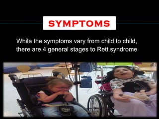 While the symptoms vary from child to child,
there are 4 general stages to Rett syndrome
SYMPTOMS
 