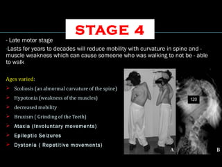 STAGE 4
- Late motor stage
-Lasts for years to decades will reduce mobility with curvature in spine and -
muscle weakness which can cause someone who was walking to not be - able
to walk
Ages varied:
 Scoliosis (an abnormal curvature of the spine)
 Hypotonia (weakness of the muscles)
 decreased mobility
 Bruxism ( Grinding of the Teeth)
 Ataxia (Involuntary movements)
 Epileptic Seizures
 Dystonia ( Repetitive movements)
 