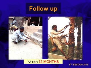 6TH BSSCON 2015
Follow up
AFTER 12 MONTHS
 