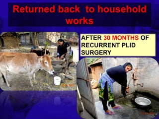 6TH BSSCON 2015
Returned back to household
works
AFTER 30 MONTHS OF
RECURRENT PLID
SURGERY
 