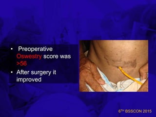 6TH BSSCON 2015
• Preoperative
Oswestry score was
>56
• After surgery it
improved
 