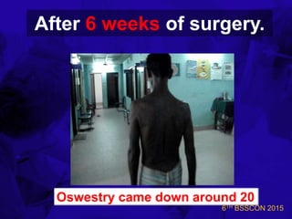6TH BSSCON 2015
After 6 weeks of surgery.
Oswestry came down around 20
 