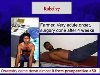 6TH BSSCON 2015
Rubel 27
Farmer, Very acute onset,
surgery done after 4 weeks
Oswestry came down almost 0 from preoperative >50
 