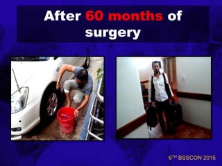 6TH BSSCON 2015
After 60 months of
surgery
 