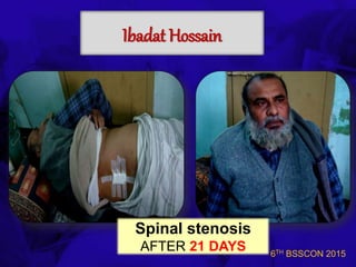 6TH BSSCON 2015
Ibadat Hossain
Spinal stenosis
AFTER 21 DAYS
 