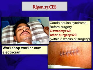 6TH BSSCON 2015
Ripon 27,CES
Cauda equina syndrome,
Before surgery
Oswestry>60
After surgery<20
(within 3 weeks of surgery)
Workshop worker cum
electrician
 