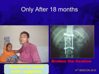 6TH BSSCON 2015
Only After 18 months
Started to stand
with supports
Broken the fixation
 
