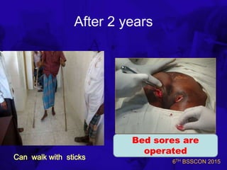 6TH BSSCON 2015
After 2 years
Bed sores are
operated
 