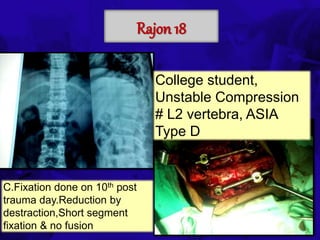 6TH BSSCON 2015
Rajon 18
College student,
Unstable Compression
# L2 vertebra, ASIA
Type D
C.Fixation done on 10th post
trauma day.Reduction by
destraction,Short segment
fixation & no fusion
 