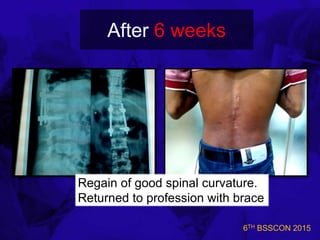 6TH BSSCON 2015
After 6 weeks
Regain of good spinal curvature.
Returned to profession with brace
 