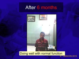 6TH BSSCON 2015
After 6 months
Doing well with normal function
 