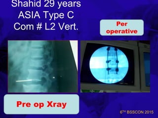 6TH BSSCON 2015
Shahid 29 years
ASIA Type C
Com # L2 Vert.
Pre op Xray
Per
operative
 