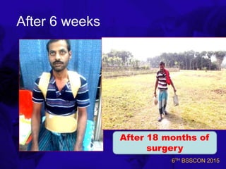 6TH BSSCON 2015
After 6 weeks
After 18 months of
surgery
 