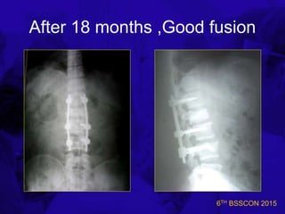 6TH BSSCON 2015
After 18 months ,Good fusion
 