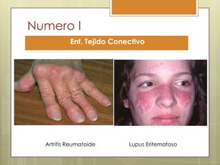 Numero I
           Enf. Tejido Conectivo




  Artritis Reumatoide      Lupus Eritematoso
 
