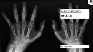 Reumatoidni
artritis
By: Maljik Miloš
 