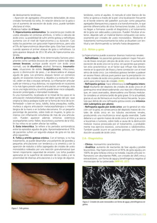 R e u m a t o l o g í a
de deslizamiento tendinoso.
- Aparición de agregados clínicamente detectables de estos
cristales formando los tofos. En relación directa con la gota o
con el aumento de excreción de ácido úrico, puede también
afectarse el riñón.
Podemos hablar de 4 fases:
1. Hiperuricemia asintomática. Se caracteriza por niveles de
uratos elevados sin síntomas artríticos, ni tofos o cálculos de
ácido úrico. La posibilidad de sufrir artritis gotosa y nefrolitiasis
aumenta con el nivel de hiperuricemia y su duración. Casi
todos los pacientes con gota están hiperuricémicos, pero sólo
el 5% de hiperuricémicos desarrollan gota. Esta fase concluye
cuando aparece el primer ataque de gota o nefrolitiasis. La
gota aparece después de 20 ó 30 años de hiperuricemia sostenida.
2. Artritis gotosa aguda. Ante determinados factores precipitantes como cambios bruscos de uricemia (sobre todo descensos bruscos, aunque puede ocurrir con ácido úrico
normal), uso de diuréticos, alcohol, fármacos, traumatismos, situaciones de estrés (hospitalización, infecciones,
ayuno o disminución de peso...) se desencadena el ataque
agudo de gota. Los primeros ataques tienen un comienzo
agudo, en ocasiones nocturno y, dejados a su evolución natural, ceden en días o escasas semanas. La inflamación articular
suele ser intensa y muy dolorosa, no soportando en ocasiones
ni la más ligera presión sobre la articulación; sin embargo, ésta
no es una regla estricta y la artritis puede tener inicio solapado,
duración prolongada e intensidad moderada.
Es una monoartritis, localizada en la mitad de los casos en la
articulación metatarsofalángica del dedo gordo del pie –que
origina la clásica podagra (suele ser la forma de inicio de la enfermedad)– o bien en tarso, tobillo, bolsa preaquílea, rodilla,
muñeca o alguna articulación metacarpofalángica o interfalángica de la mano o en la bolsa olecraniana. En un pequeño
porcentaje de pacientes, sobre todo en mujeres, la gota comienza con inflamación simultánea de más de una articulación. Pueden aparecer además síntomas sistémicos
acompañantes como: fiebre, leucocitosis y aumento de la VSG.
En los niños no se suelen afectar las rodillas.
3. Gota intercrítica. Se refiere a los períodos asintomáticos
entre los episodios agudos de gota. Aproximadamente el 75%
de pacientes sufren un segundo ataque de gota en los dos
años siguientes.
4. Tofos y artritis gotosa crónica. Con el tiempo, si no hay
tratamiento, se puede desarrollar una poliartritis de grandes y
pequeñas articulaciones con tendencia a la simetría y con la
aparición de nódulos o tofos (agregados de cristales de urato
monosódico rodeados por una reacción granulomatosa) que
tienen importante capacidad de erosión. Los tofos pueden
apreciarse en la superficie de extensión de los codos y en la
proximidad de diversas articulaciones o a lo largo de algunos

tendones, como el aquíleo. A menudo el color blanco de los
tofos se aprecia a través de la piel. Una localización frecuente
es el borde externo del pabellón auricular como pequeños
agregados blanquecinos y opacos a la transiluminación, lo que
permite diferenciarlos de otras formaciones locales. Los tofos
no llegan a formarse cuando el diagnóstico y el tratamiento
de la gota son adecuados y precoces. Pueden fistulizar al exterior, dejando salir un material blanco compuesto casi exclusivamente por cristales de urato monosódico. Mediante el
tratamiento normouricemiante los tofos se disuelven con lentitud y van disminuyendo su tamaño hasta desaparecer.

2.3.- Riñón y gota
La hiperuricemia puede ocasionar diversos trastornos renales:
- Nefrolitiasis: los pacientes gotosos padecen mayor frecuencia de litiasis renal por cálculos de ácido úrico. El aumento de
excreción de ácido úrico en la orina –en pacientes que presentan esta característica– es el factor que influye más directamente en la aparición de litiasis y tiene correlación con el nivel
sérico de ácido úrico. Los individuos gotosos tienden a padecer
en exceso litiasis cálcicas pues parece que la precipitación inicial de cristales de ácido úrico podría servir de centro de nucleación para otros tipos de cristales (MIR).
- Nefropatía gotosa: hace referencia a la nefropatía intersticial resultante del depósito de cristales de ácido úrico en el
parénquima renal desencadenando una reacción inflamatoria
que, en casos avanzados, desencadena una fibrosis medular.
Se considera un síntoma tardío de gota grave. En la actualidad,
gracias al uso de fármacos es mucho menos frecuente. Se postula que detrás de una nefropatía gotosa existe una intoxicación subrepticia por plomo.
- Nefropatía aguda por ácido úrico: por lo general sin relación con la gota, es consecuencia del depósito masivo de cristales de ácido úrico en los túbulos excretores renales,
produciendo una insuficiencia renal aguda reversible. Suele
deberse a un aporte masivo de ácido úrico al riñón y se asocia
a leucemias o tumores, sobre todo a causa de la destrucción
medular masiva provocada por el tratamiento, y probablemente tras ejercicio excesivo, convulsiones o rabdomiólisis.
También puede ocurrir en pacientes gotosos, con hiperproducción acusada de ácido úrico.

2.4.- Diagnóstico
- Clínica: monoartritis característica.
- Analítica: aumento de reactantes de fase aguda y posible
leucocitosis. Hay hiperuricemia en el 95% de gota aguda y en
100% de gota tofácea crónica no tratada. Líquido articular inflamatorio con abundantes PMN, con cristales de UMS intra y
extracelulares, con forma de aguja y birrefringencia negativa al
microscopio de luz polarizada (MIR 03, 227).

Figura 2. Cristales de urato monosódico con forma de aguja y birrefringencia negativa.
Figura 1. Tofo gotoso.
] ARTRITIS POR MICROCRISTALES [ 13

 