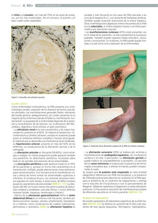 Manual A Mir

www.academiamir.com

el riñón y el corazón, con más del 70% en las series de autopsia, son los más involucrados. Por el contrario, el pulmón y el
bazo suelen estar respetados.

variable y más frecuente en los casos de PAN asociada a los
virus de la hepatitis B o C, con aumento de fosfatasas alcalinas.
También puede ocasionar aneurismas de la arteria hepática.
Otras manifestaciones digestivas menos frecuentes de la PAN
son la colecistitis, el infarto hepático masivo o el infarto pancreático por afectación vascular.
- Las manifestaciones cutáneas (43%) están presentes casi
en la mitad de los pacientes. La más característica es la púrpura
palpable. También pueden aparecer livedo reticularis, ulceraciones o acrocianosis. En ocasiones, la PAN puede quedar limitada a la piel como única expresión de la enfermedad.

Figura 1. Vasculitis con oclusión vascular.

Cuadro clínico
Como enfermedad multisistémica, la PAN presenta una sintomatología variada, expresión de los diversos territorios vasculares afectados. Las manifestaciones generales (fiebre, afectación
del estado general, adelgazamiento, etc.) están presentes en la
mayoría de los enfermos (siendo la fiebre su manifestación fundamental). La gravedad de la enfermedad depende de la extensión y la localización de las lesiones; así, la afectación del SNC,
cardíaca, digestiva y renal entraña un peor pronóstico.
- La afectación renal es la más característica y de mayor trascendencia, presente en el 60%. Se traduce en proteinuria, microhematuria y cilindros celulares, aunque en ocasiones puede
existir un síndrome nefrótico completo o fracaso renal agudo.
Es habitual que se desarrolle una insuficiencia renal moderada.
La hipertensión arterial, presente en más del 50% de los
enfermos, es consecuencia de la afectación vascular y de la
nefropatía
- La afectación articular es frecuente (50-60%), como artralgias y mialgias. En menor proporción puede aparecer también
una poliartritis no deformante asimétrica, localizada sobre
todo en las grandes articulaciones de las extremidades.
- La neuropatía periférica puede aparecer hasta en el 70%
de los pacientes y, aunque su forma más característica es la
mononeuritis múltiple, puede exteriorizarse como polineuropatía sensitivomotora. Con frecuencia es la manifestación inicial y afecta de forma similar las extremidades superiores e
inferiores. El comienzo brusco, con síntomas sensitivos intensos seguidos en corto tiempo, a veces horas, de déficit motores
graves es característico de esta entidad (MIR 97, 117). La afectación del SNC es mucho menos frecuente (cuadros de disfunción cerebral o cerebelosa -vasculitis difusa- o como defectos
motores focales -isquemia, hemorragia o infarto-).
- Dentro de la afectación gastrointestinal (44%) el dolor
abdominal difuso es su síntoma más frecuente, también podemos encontrar náuseas, vómitos, estreñimiento, hematemesis o melenas, como consecuencia de cuadros suboclusivos,
perforativos o ulcerativos (MIR). La afectación hepática es

18 ] VASCULITIS [

Figura 2. Evolución de la afectación cutánea de la PAN con úlceras cutáneas.

- La afectación coronaria (34%) se traduce por arritmias y
manifestaciones de cardiopatía isquémica, con insuficiencia
cardíaca o sin ella, o pericarditis. La afectación genital se
puede traducir en orquiepididimitis o prostatitis. La vasculitis
de los vasos retinianos se traduce por la presencia de hemorragias o exudados que, si afectan la mácula, pueden comprometer la visión.
Se acepta que el pulmón está respetado en esta entidad
(diagnóstico diferencial con PAN microscópica), y la presencia
de infiltrados pulmonares descritos en ocasiones en la PAN apoyaría la existencia de un síndrome de solapamiento u overlap
con la vasculitis de Churg-Strauss o con la granulomatosis de
Wegener. Debemos replantear el diagnóstico si existe afectación
pulmonar. Es frecuente la asociación de manifestaciones propias
de diferentes vasculitis en el mismo paciente (MIR 04, 12).

Pruebas de laboratorio
No existen parámetros de laboratorio específicos de la enfermedad (MIR 99, 85). Se observa un aumento de la VSG y de reactantes de fase aguda (plaquetas, fibrinógeno, haptoglobina,

 