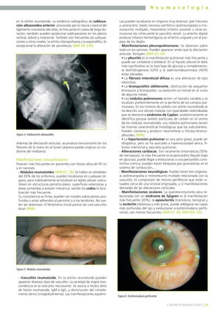R e u m a t o l o g í a
en la artritis reumatoide. La evidencia radiográfica de subluxación atloaxoidea anterior, provocada por la rotura o laxitud del
ligamento transverso del atlas, es frecuente en casos de larga duración; también pueden producirse subluxaciones en los planos
vertical, lateral y rotacional. También son frecuentes las subluxaciones a otros niveles, la artritis interapofisaria y la espondilitis. Es
excepcional la alteración de sacroilíacas (MIR 98, 236).

Figura 4. Subluxación atloaxoidea.

Además de afectación articular, se produce tenosinovitis (en los
flexores de la mano en el túnel carpiano puede originar un síndrome del mediano).

Manifestaciones extraarticulares
Parecen más frecuentes en pacientes con títulos altos de FR (+)
y en varones.
- Nódulos reumatoides (MIR 07, 78). Se hallan en alrededor
del 20% de los enfermos, pueden localizarse en cualquier órgano, pero habitualmente se localizan en tejido celular subcutáneo en estructuras periarticulares, superficies extensoras y
áreas sometidas a presión mecánica, siendo los codos la localización más frecuente.
Su consistencia es firme; pueden ser móviles sobre planos profundos o estar adheridos al periostio o a los tendones. No suelen ser dolorosos. El fenómeno inicial parece ser una vasculitis
local (MIR).

cas pueden localizarse en órganos muy diversos: piel (necrosis
y ulceración), tejido nervioso periférico (polineuropatía o mononeuritis múltiple), mesenterio (infarto visceral) u otras estructuras (es infrecuente la vasculitis renal). La arteritis digital
produce infartos hemorrágicos en el lecho ungueal y en el pulpejo de los dedos.
- Manifestaciones pleuropulmonares. Se observan sobre
todo en los varones. Pueden aparecer antes que la afectación
articular. Incluyen (MIR 02, 26):
• La pleuritis es la manifestación pulmonar más frecuente y
puede ser unilateral o bilateral. En el líquido pleural el dato
más significativo es la tasa baja de glucosa y complemento;
la deshidrogenasa (LDH) y la adenosindesaminasa (ADA)
están elevadas.
• La fibrosis intersticial difusa es una alteración de tipo
restrictivo.
• La bronquiolitis obliterante, obstrucción de pequeños
bronquios y bronquiolos. La evolución es mortal en el curso
de algunos meses.
• Los nódulos pulmonares tienen un tamaño variable y se
localizan preferentemente en la periferia de los campos pulmonares. En los mineros de carbón con artritis reumatoide se
ha descrito una silicosis nodular con opacidades redondeadas
que se denomina síndrome de Caplan; anatómicamente se
identifica porque existen partículas de carbón en el centro
de los nódulos reumatoides. Los nódulos pulmonares tienen
las mismas características histológicas que los subcutáneos.
Pueden cavitarse y producir neumotórax o fístulas broncopleurales (MIR).
• La hipertensión pulmonar es rara pero grave; puede ser
idiopática, pero se ha asociado a hiperviscosidad sérica, fibrosis intersticial y vasculitis pulmonar.
- Alteraciones cardíacas. Son raramente sintomáticas (50%
de necropsias); lo más frecuente es la pericarditis (líquido bajo
en glucosa), puede llegar a evolucionar a una pericarditis constrictiva crónica; pueden existir bloqueos por granulomas en el
sistema de conducción,...
- Manifestaciones neurológicas. Pueden tener tres orígenes:
a) polineuropatía o mononeuritis múltiple relacionada con la
vasculitis; b) compresión de nervios periféricos que están situados cerca de una sinovial engrosada, y c) manifestaciones
derivadas de las alteraciones cervicales.
- Manifestaciones oculares. La queratoconjutivitis seca relacionada con un síndrome de Sjögren es la manifestación
más frecuente (20%), la epiescleritis (transitoria, benigna) y
la escleritis (dolorosa y más grave, puede adelgazar las capas
más profundas del ojo y evolucionar a escleromalacia perforante), son menos frecuentes (MIR 01, 83; MIR 00F, 92).

Figura 5. Nódulos reumatoides.

- Vasculitis reumatoide. En la artritis reumatoide pueden
aparecer diversos tipos de vasculitis. La variedad de mayor trascendencia es la vasculitis necrosante. Se asocia a títulos altos
de factor reumatoide, IgM e IgG, y disminución del complemento sérico (crioglobulinemia). Las manifestaciones isquémi-

Figura 6. Escleromalacia perforante.
] ARTRITIS REUMATOIDE [ 29

 