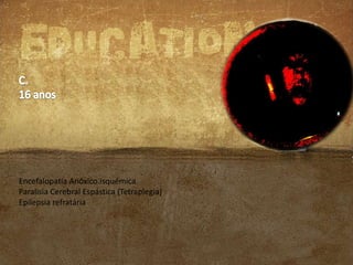 Encefalopatia Anóxico.isquémica
Paralisia Cerebral Espástica (Tetraplegia)
Epilepsia refratária

 