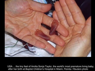 USA ... the tiny feet of Amilia Sonja Taylor, the world's most premature living baby, after her birth at Baptist Children's Hospital in Miami, Florida / Reuters photo  
