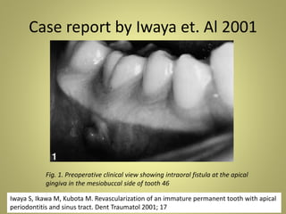 Case report by Iwaya et. Al 2001
27 November 2016 14
Fig. 1. Preoperative clinical view showing intraoral fistula at the apical
gingiva in the mesiobuccal side of tooth 46
Iwaya S, Ikawa M, Kubota M. Revascularization of an immature permanent tooth with apical
periodontitis and sinus tract. Dent Traumatol 2001; 17
 