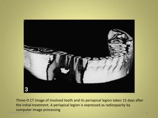 27 November 2016 16
Three-D CT image of involved tooth and its periapical legion taken 15 days after
the initial treatment. A periapical legion is expressed as radioopacity by
computer image processing
 