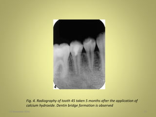 27 November 2016 17
Fig. 4. Radiography of tooth 45 taken 5 months after the application of
calcium hydroxide. Dentin bridge formation is observed
 