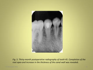 27 November 2016 18
Fig. 5. Thirty-month postoperative radiography of tooth 45. Completion of the
root apex and increase in the thickness of the canal wall was revealed.
 