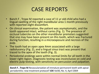 CASE REPORTS
• Banch F , Trope M reported a case of 11 yr old child who had a
lingual swelling of the right mandibular area 1 month previously
with reported slight discomfort.
• On clinical examination, the patient was asymptomatic, and the
tooth appeared intact, without caries (Fig. 1). The presence of
occlusal tubercles on the other mandibular premolars suggested
that one may have been present on this tooth, which was fractured
during function, resulting in a microexposure and necrosis of the
pulp.
• The tooth had an open apex 4mm associated with a large
radiolucency (Fig. 2), and a lingual sinus tract was present that
traced to the apex of the tooth (Fig. 3).
• Periodontal probings were within normal limits for all teeth in the
lower right region. Diagnostic testing was inconclusive on cold and
electric pulp testing, with sensitivity on percussion and palpation.
27 November 2016 47
Banch F , Trope M Revascularization of immature permanent teeth with apical
periodontitis: new treatment protocol? JOE Vol30, No. 4, April 2004
 