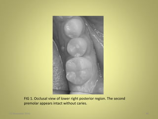 27 November 2016 48
FIG 1. Occlusal view of lower right posterior region. The second
premolar appears intact without caries.
 