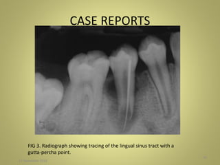 CASE REPORTS
27 November 2016
50
FIG 3. Radiograph showing tracing of the lingual sinus tract with a
gutta-percha point.
 