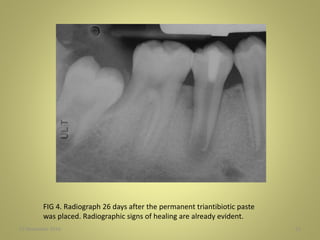 27 November 2016 51
FIG 4. Radiograph 26 days after the permanent triantibiotic paste
was placed. Radiographic signs of healing are already evident.
 