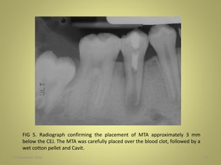 27 November 2016 52
FIG 5. Radiograph confirming the placement of MTA approximately 3 mm
below the CEJ. The MTA was carefully placed over the blood clot, followed by a
wet cotton pellet and Cavit.
 