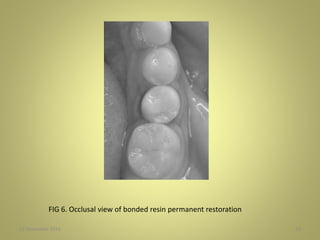 27 November 2016 53
FIG 6. Occlusal view of bonded resin permanent restoration
 