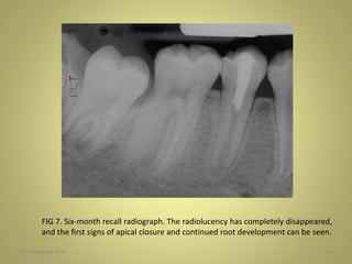 27 November 2016 54
FIG 7. Six-month recall radiograph. The radiolucency has completely disappeared,
and the first signs of apical closure and continued root development can be seen.
 