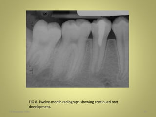 27 November 2016 55
FIG 8. Twelve-month radiograph showing continued root
development.
 
